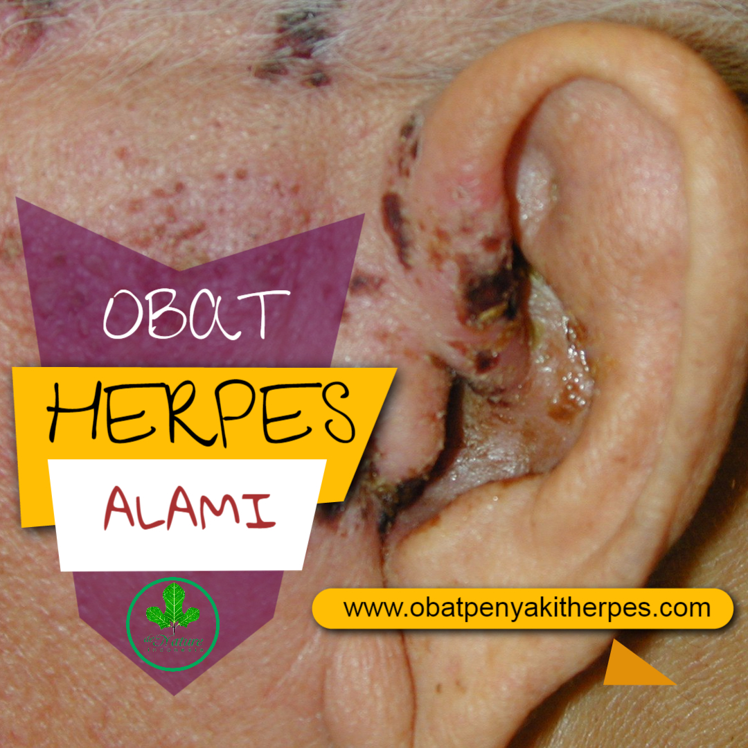 Cara Menghilangkan Bekas Herpes | blog pelajar